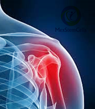 Slider image (9) MexStemCells Clinic